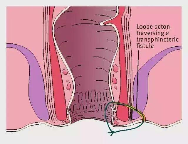 沈阳省医肛肠研究所 医识 肛瘘前期症状有哪些有什么危害 